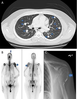 TERT Promoter Mutations Are an Independent Predictor of Distant Metastasis in Middle Eastern Papillary Thyroid Microcarcinoma